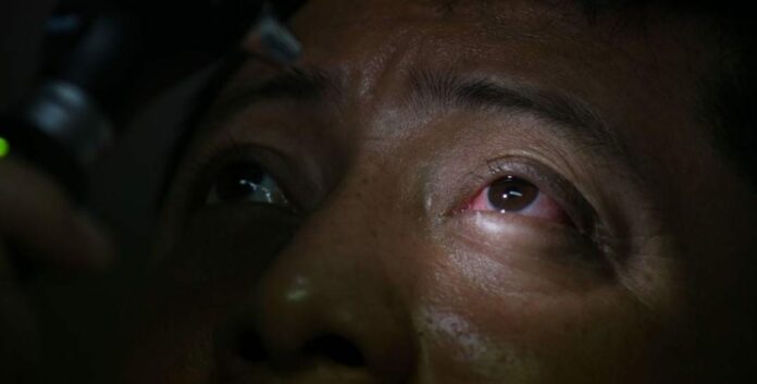conjuntivitis Una investigadora señala que la conjuntivitis podría manifestarse como un síntoma de contagio de la variante Ómicron. ¿Qué tal? Foto: RT