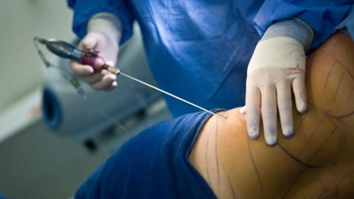Muere mujer tras someterse a una liposucción en Chiapas